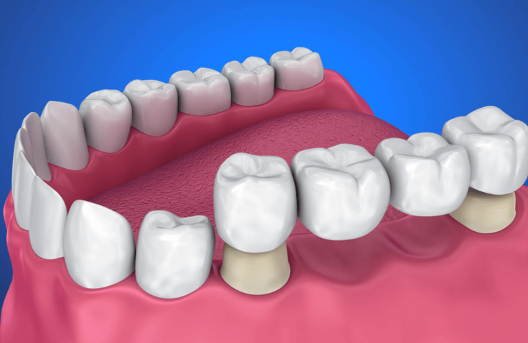 Dental Bridges in Hamilton