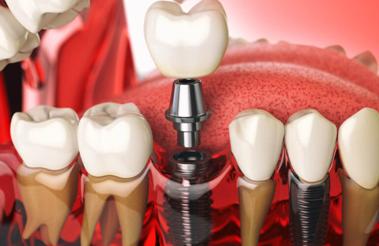 Dental Implants in Hamilton